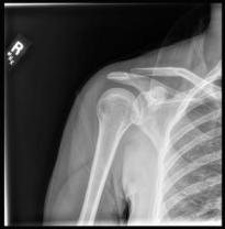 X-ray of the fractured collarbone that ended the 2019 RAAM attempt